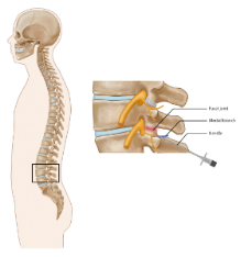 Epidural in back