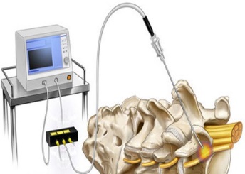 Radiofrequency Ablation