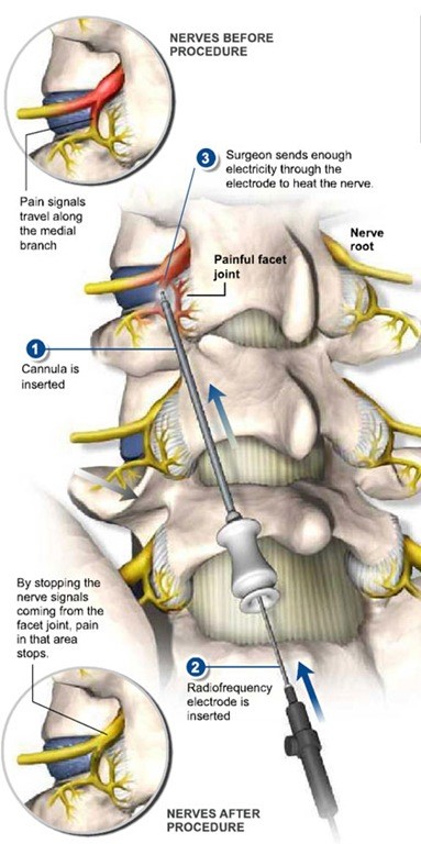 Nerves before Radiofrequency Ablation versus nerves after procedure